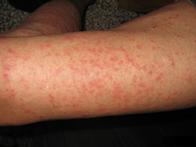 湿疹有哪些常见的治疗方法